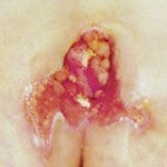 wound