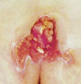 wound