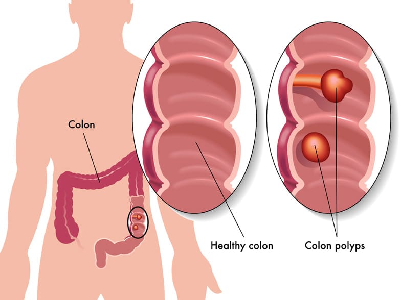 colon