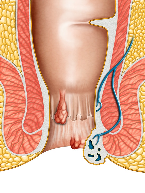 internal-external-hemorrhoids