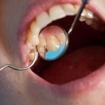 New Photoacoustic Root Canal Technique