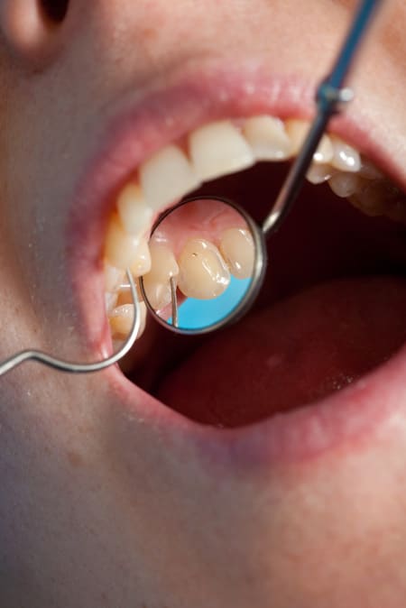 New Photoacoustic Root Canal Technique