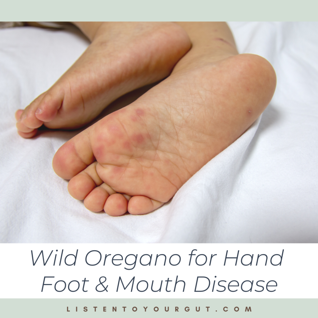 Wild Oregano for Hand Foot & Mouth Disease